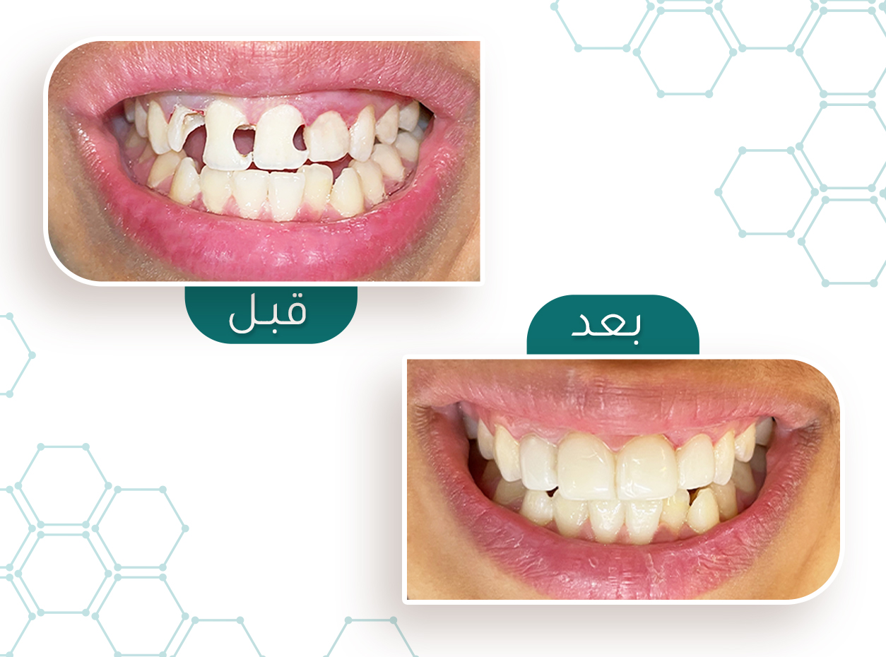 حالة تسوس — قبل وبعد