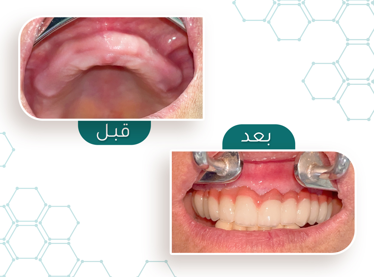 حالة زراعة — قبل وبعد