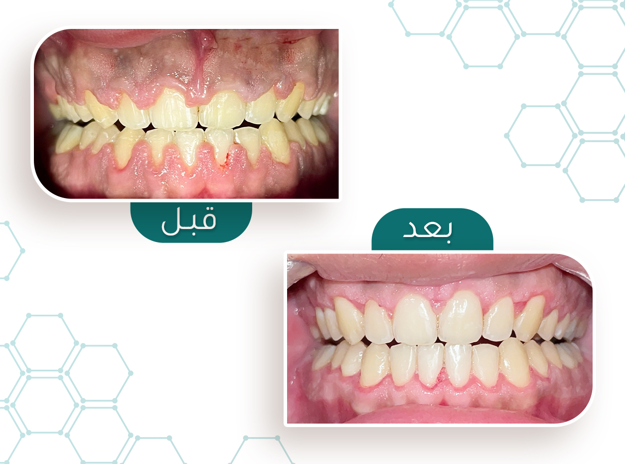 حالة لثة — قبل وبعد