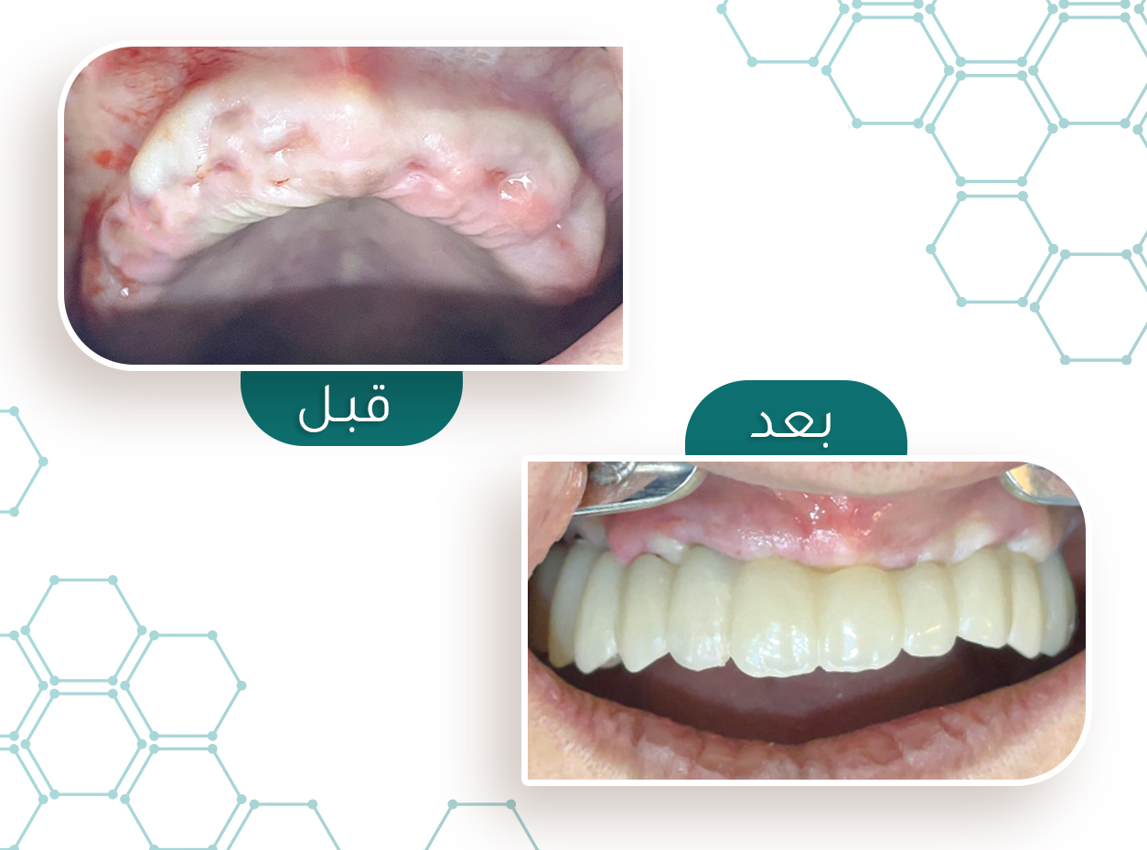 حالة زراعة أسنان — قبل وبعد