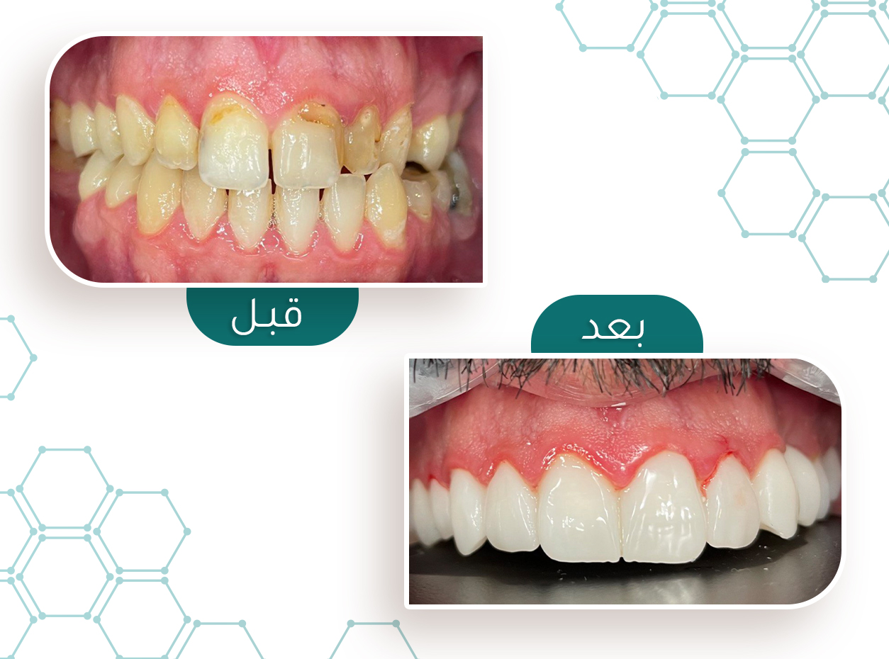 حالة فينير — قبل وبعد