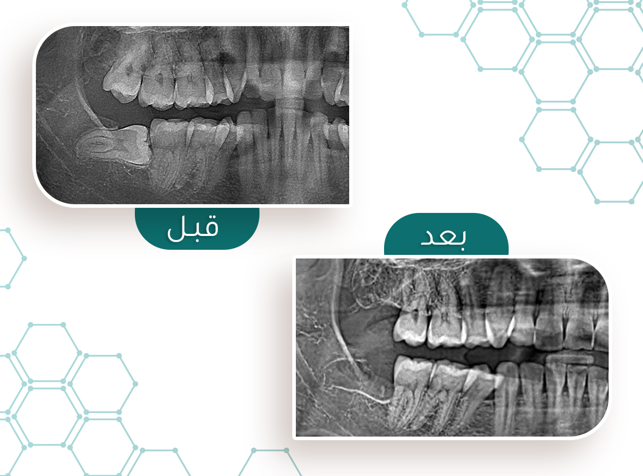 حالة خلع طاحونة العقل — قبل وبعد